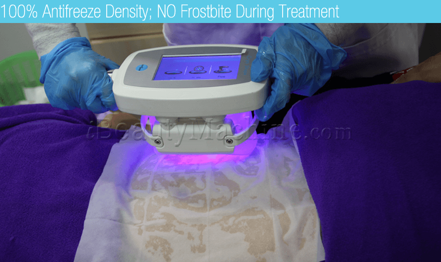 Cryolipolysis Treatment