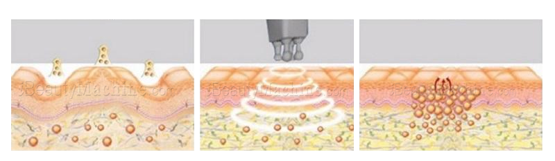 bipolar rf working principle