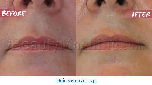 diode laser hair removal on lips
