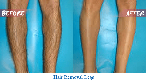 diode laser hair removal on legs before and after