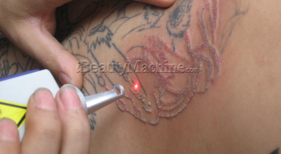 best tattoo removal laser