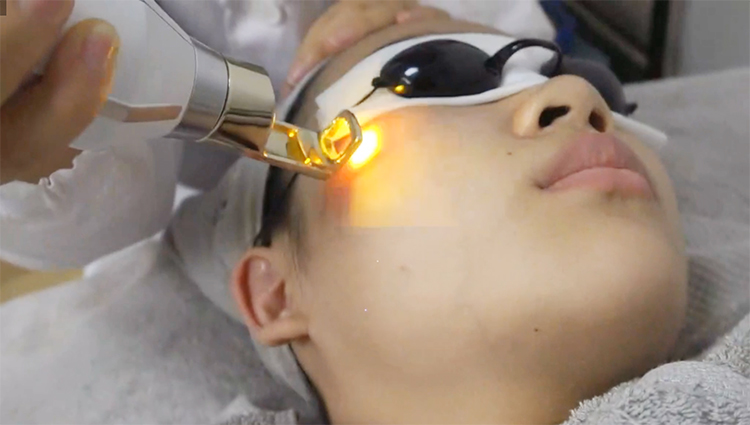 yag laser tattoo removal