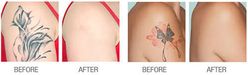 yag laser tattoo removal