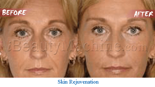 diode laser skin rejuvenation before and after
