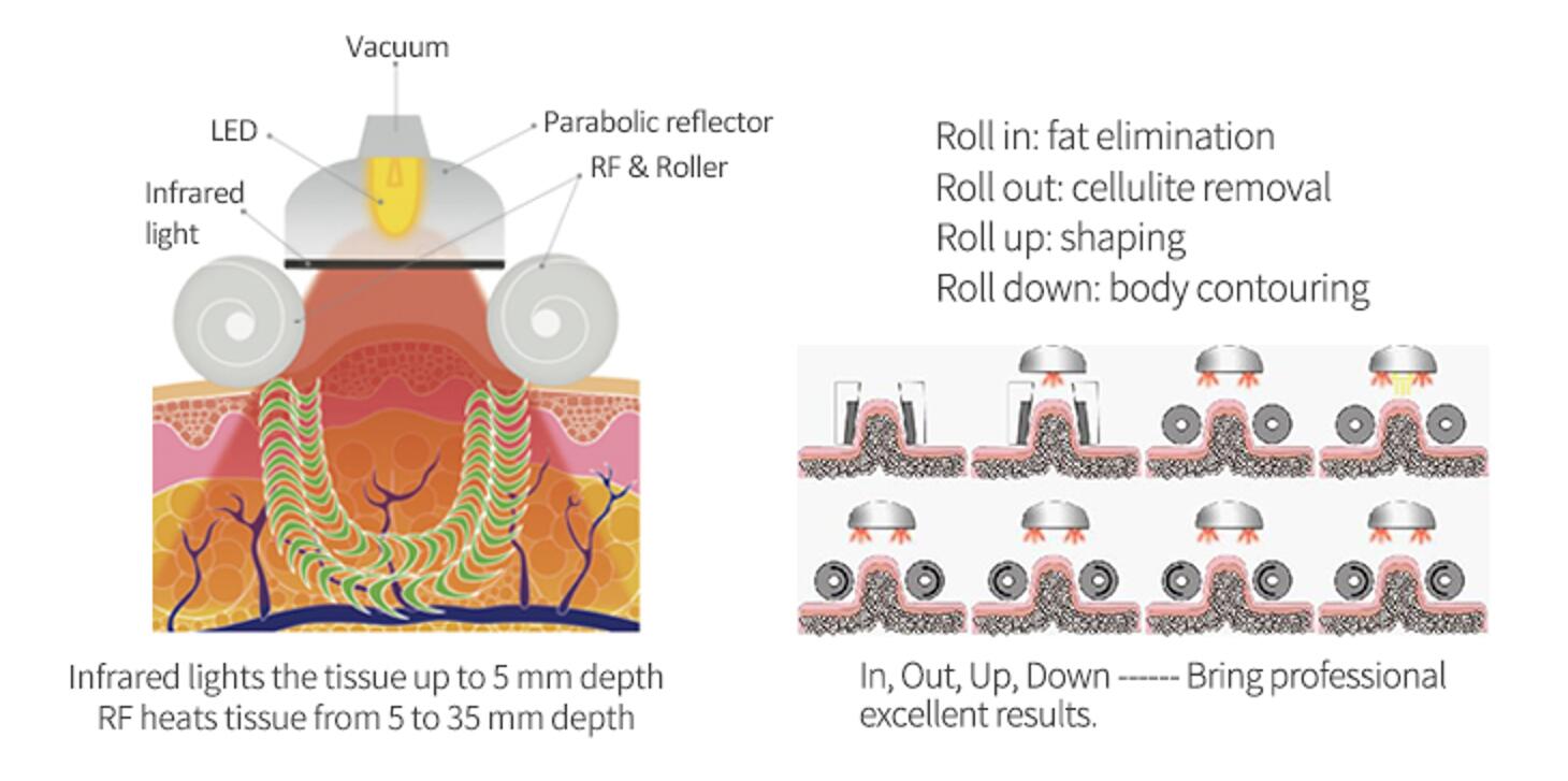 best fat cavitation machine