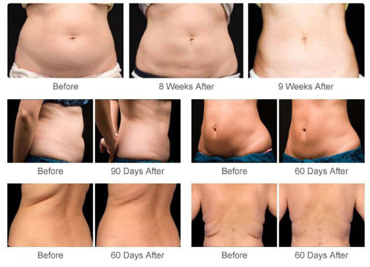 Ultraslim Ⅳ™  Professional Lipo Cavitation RF Body Contouring