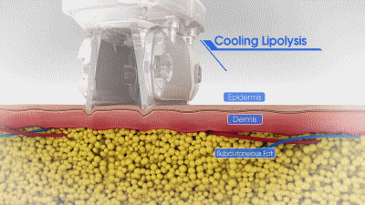 Coolipo S™ | Portable Cool Shaping Machine to freeze fat away | CoolSculpting | Two Cryolipolysis probe