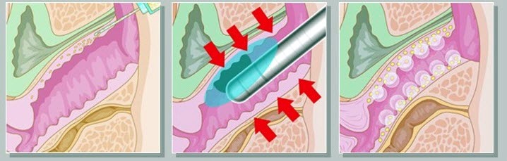 vigina tightening hifu