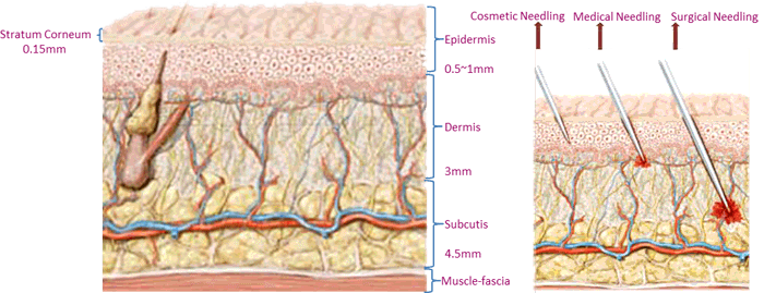 derma microneedle, derma rolling, dermaroller