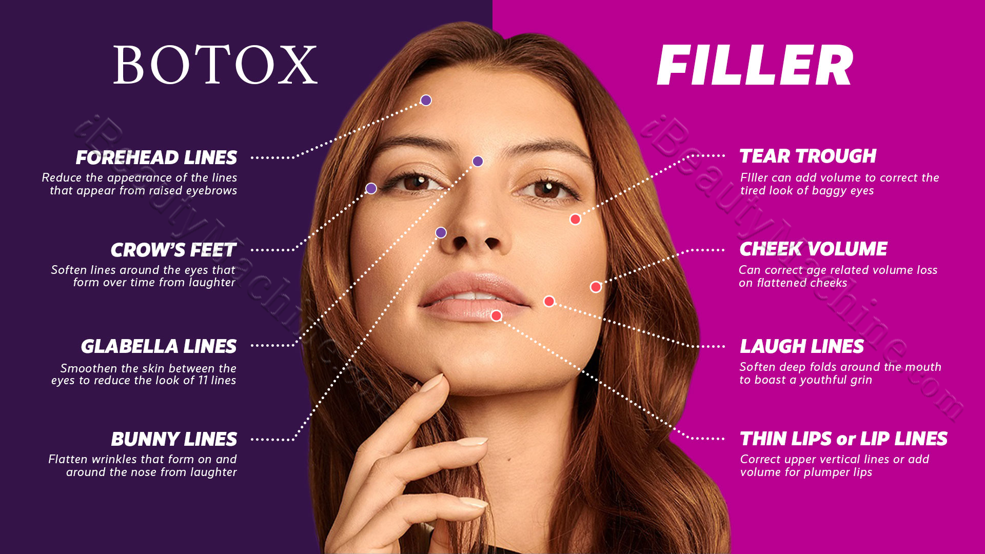 ibeautymachine botox or dermal filler