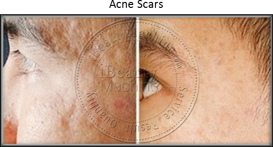 Acne Scars