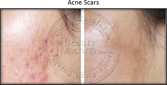 Acne Scars