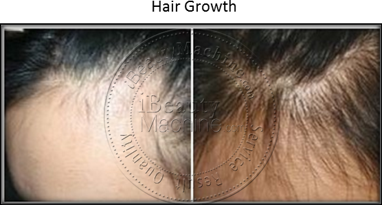 Hair Growth