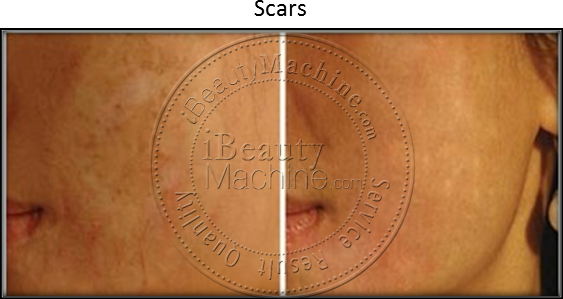 Scars