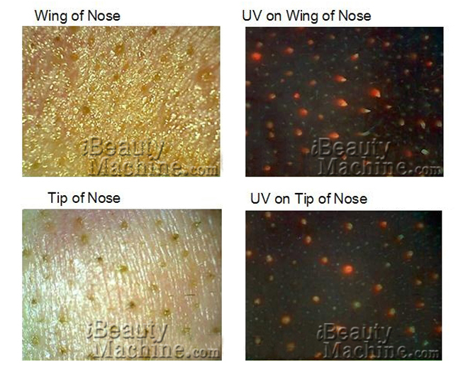 skin analysis result