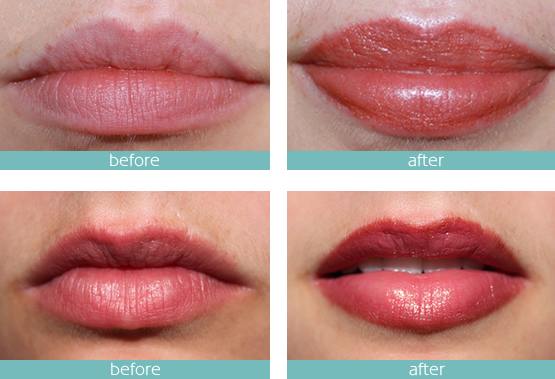 micro-pigmentation-lips-needle tips