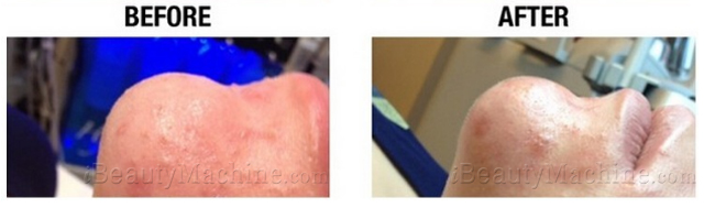 Microdermabrasion at home