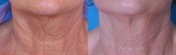 RF skin tightening BA photos