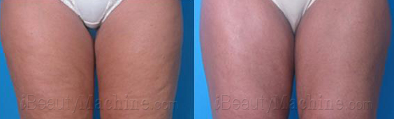 RF skin tightening BA photos