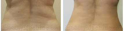 cavitation fat removal results