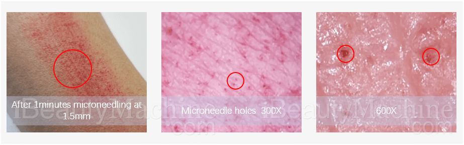 eclipse microneedle skinpen micronedling