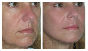 Rough wrinkle and perioral wrinkles removal BA photos